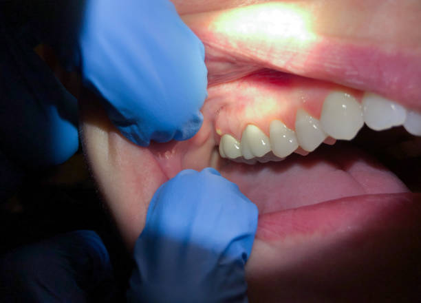Best Chipped Tooth Repair Near Me  in Spindale, NC